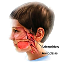 Adenoidectomia